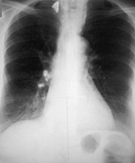 Хаммена-рича синдром (фиброзирующий альвеолит) на рентгене