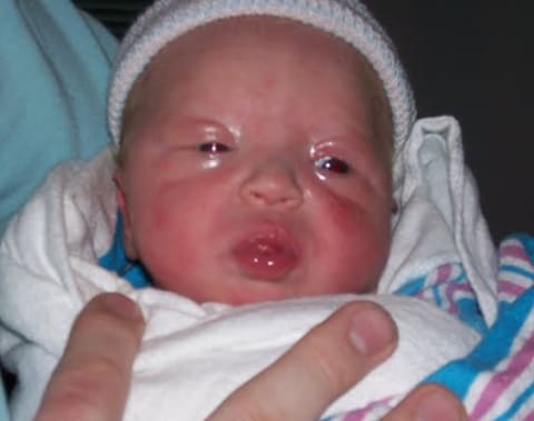 Врожденный офтальмохламидиоз у новорожденного