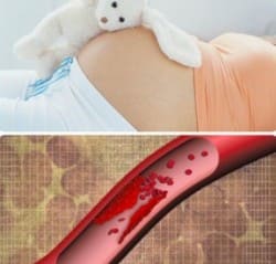 Тромбофилии и беременность
