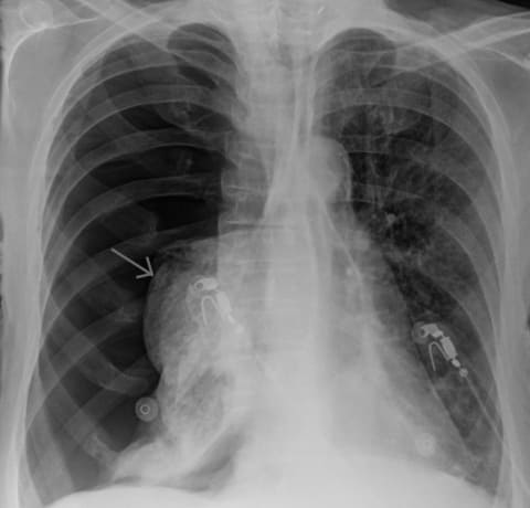 Рентгенограмма больного с правосторонним тотальным пневмотораксом