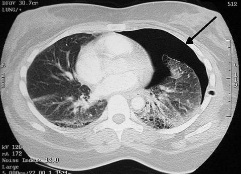 Компьютерная томограмма грудной клетки больного с левосторонним пневмотораксом 