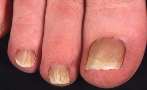 Грибок ногтей (симптомы онихомикоза)