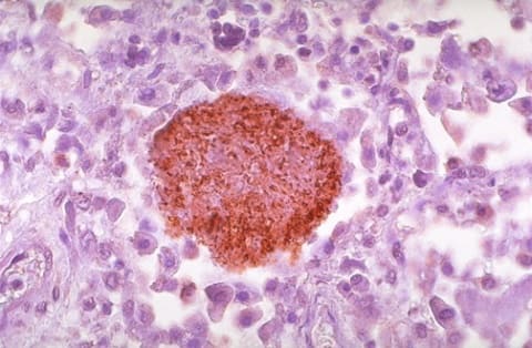 Пневмоцистная пневмония у ВИЧ-инфицированных, микроскопия