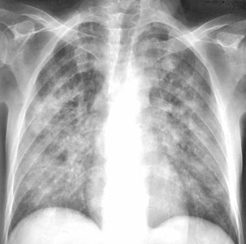 Пневмоцистная пневмония, рентгенологическая картина