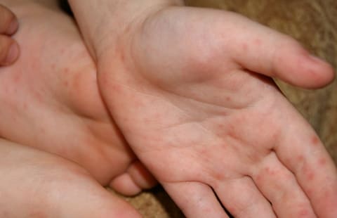 Синдром рука-нога-рот, сыпь на ладонях и стопах