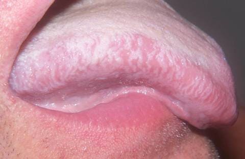 Волосатая лейкоплакия языка