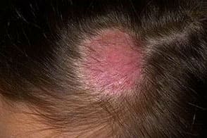 Симптомы микроспории (стригущего лишая) на волосах