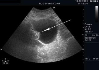 Ультразвуковая картина опухоли мочевого пузыря, стрелкой показана опухоль