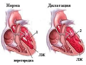 Сердечная астма