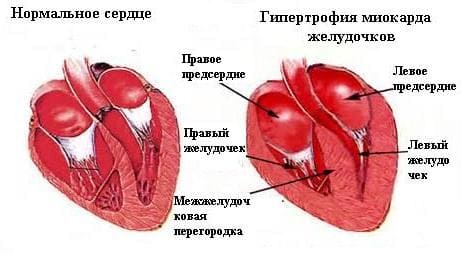Сердечная астма