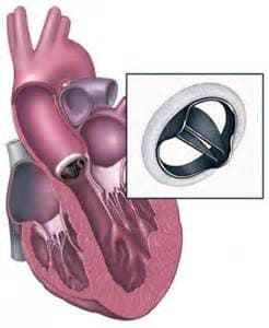 Стеноз аортального клапана приобретенный