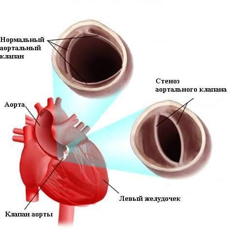 Стеноз аортального клапана (стеноз устья аорты)