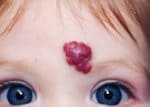 Опасна ли гемангиома для ребенка и нужно ли лечение