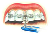 Использование зубного ёршика для очистки пространства под дугой