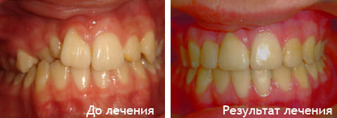 Фото исправления прикуса брекетами до и после лечения