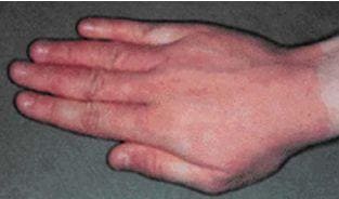 Симптомы аллергического контактного дерматита