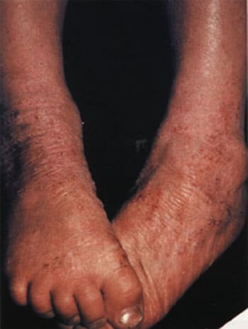 На фото: атопический дерматит. Взрослая форма симптомы