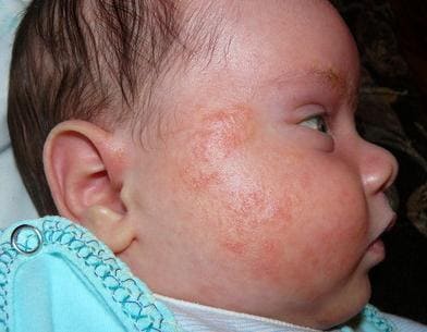 Фото аллергии у детей до года симптомы диатеза / атопический дерматит