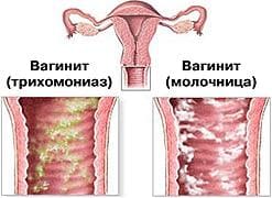 Вагинит, вызванный трихомониазом (зеленые,гнойные выделения) и вагинит, обусловленный молочницей (творожистые выделения)