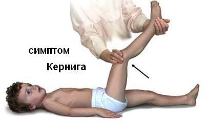 симптом Кернига (невозможность разогнуть согнутую в тазобедренном и коленном суставах ногу