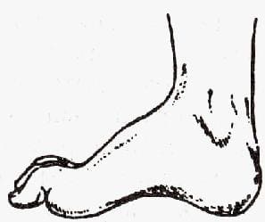 «Конская» стопа при поражении большеберцового нерва