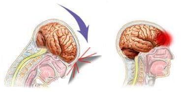 Сотрясение мозга возникает при прямом ударе или резком замедлении движения головы. Это приводит к нарушению работы мозга 