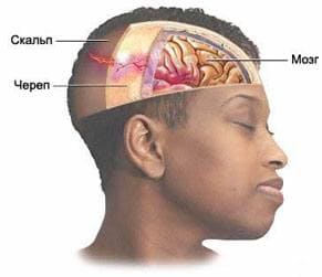 Повреждение головного мозга при переломе костей свода черепа