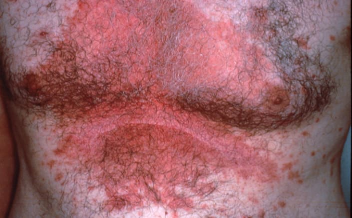 На фото симптомы себорейного дерматита тела
