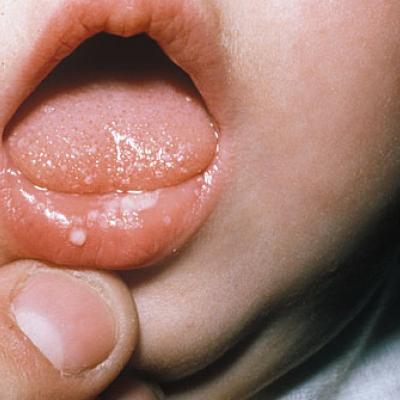 Молочница (дрожжевой стоматит) у ребенка