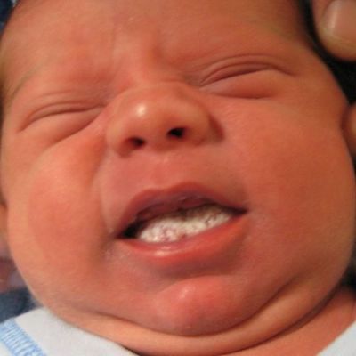 Молочница (дрожжевой стоматит) у ребенка