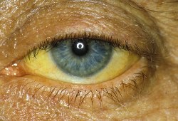 Желтушность глазного яблока при гепатите