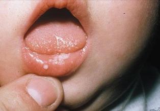 Фото симптомы стоматита у ребенка