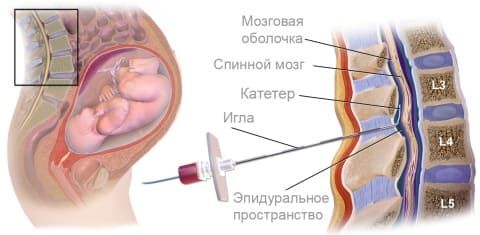 Эпидуральная анестезия при родах