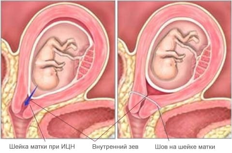 Истмико-цервикальная недостаточность (ИЦН) при беременности