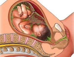 Что такое иппп в гинекологии при беременности