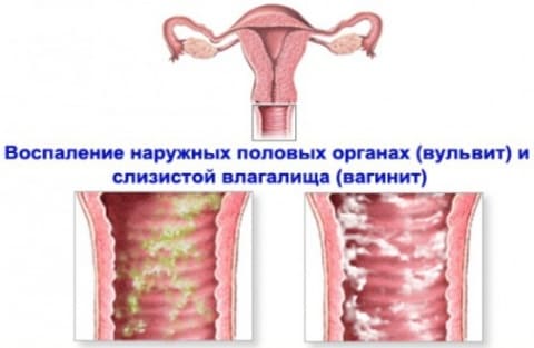Молочница при беременности