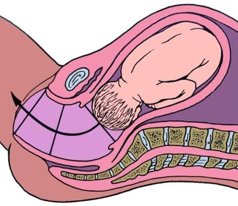 Раскрытие, укорочение шейки матки при беременности