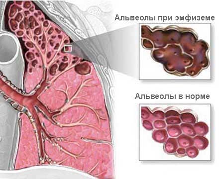 Схема строения альвеол при эмфиземе легких