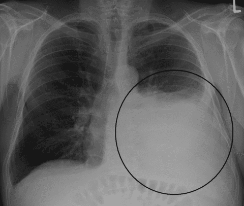 Рентгенограмма больного с левосторонним гидротораксом