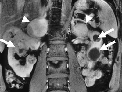 Сагиттальный снимок МРТ брюшной полости. Стрелками показаны двухсторонние феохромоцитомы надпочечников, в сочетании с карциномами