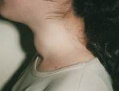 Косметический дефект шеи при крупном узловом зобе