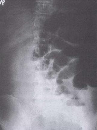 рентгенологическая картина кишечной непроходимости