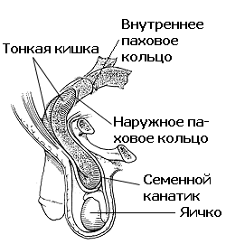 Схематическое изображение паховой грыжи у мужчины