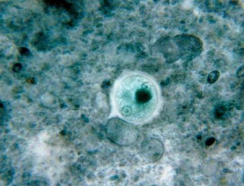 Амеба в мазке под микроскопом