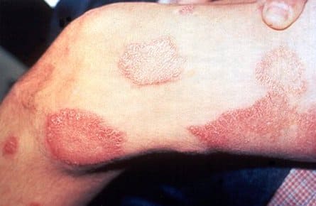 Характерные изменения кожи при туберкулоидном типе лепры