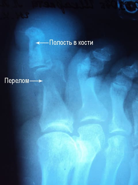 рентгенологическая картина остеомиелита
