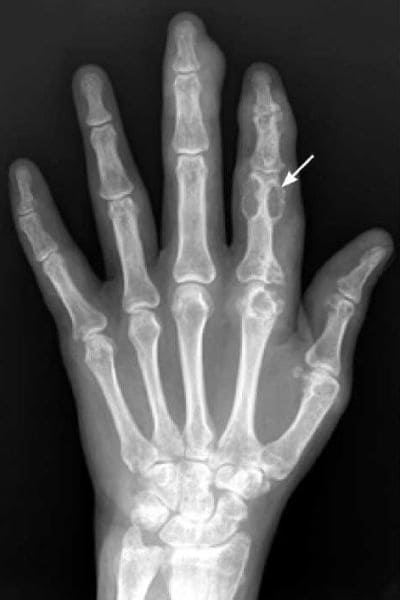 Рентгенография суставов - подагрический артрит