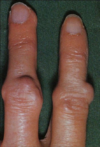 Ревматоидные узелки на пальцах кисти при ревматоидном артрите