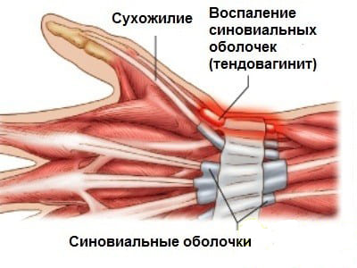 хематическое изображение тендовагинита – воспаления синовиальной оболочки фиброзного влагалища сухожилия мышцы