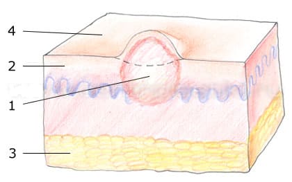 Схематическое изображение твердой фибромы кожи